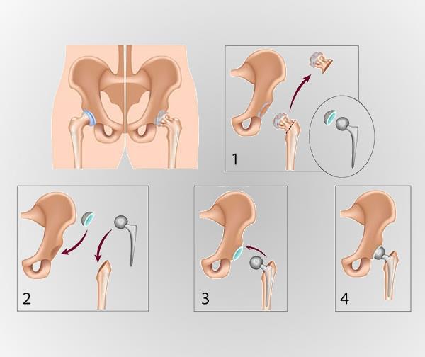  Replacing the Hip – All about Hip Replacement Surgery