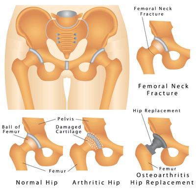  Hip Replacement Surgery 