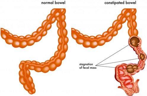 Laxatives: Constipation Relief
