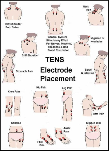 Transcutaneous Electrical Nerve Stimulation (TENS) - A Canadian Primer ·  Dunbar Medical