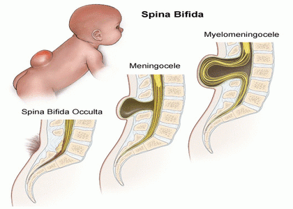 spina bifida hair patch