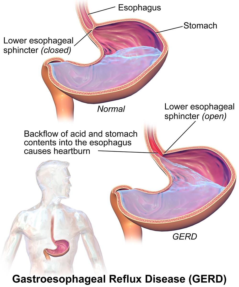 Acid Reflux - Symptoms and Common causes