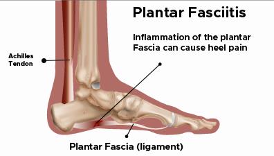 Plantar fasciitis Plantar fasciitis