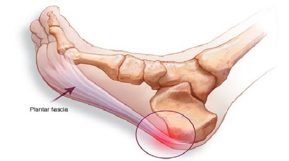 Plantar Fasciitis