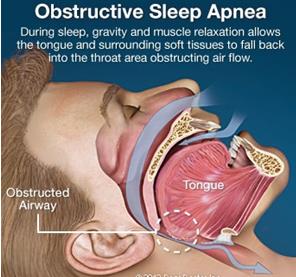 Obstructive Sleep Apena