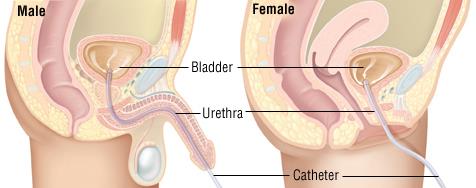 Intermittent Catheters