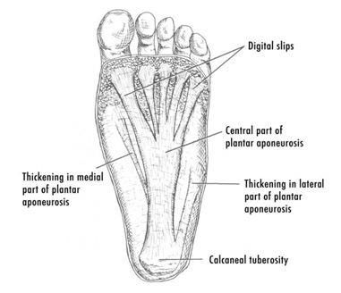 Plantar Fasciitis: Risks and Diagnosis