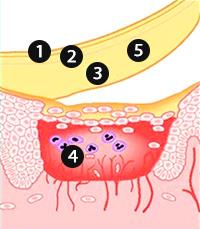 DuoDerm