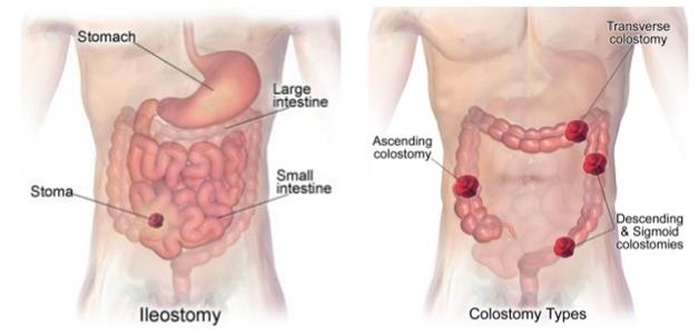 Ostomy Types