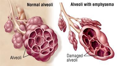 Medical Care for Emphysema Patients