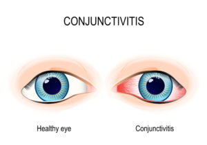 Conjunctivitis Conjunctivitis