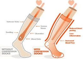 What Do Compression Stockings Do? What Do Compression Stockings Do?