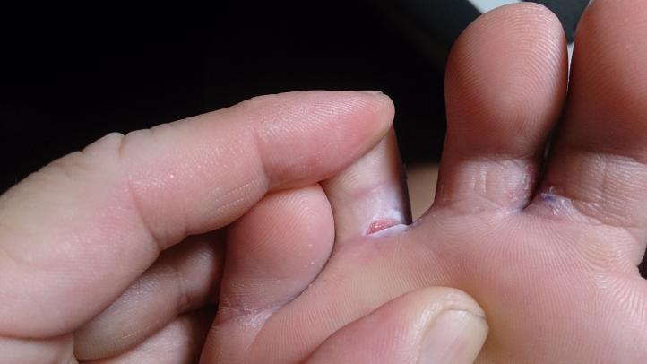 Athlete’s Foot - Causes, Symptoms, and Cures