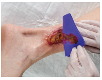 How to use Hydrofera Blue? Hydrofera Blue Ready Dressing