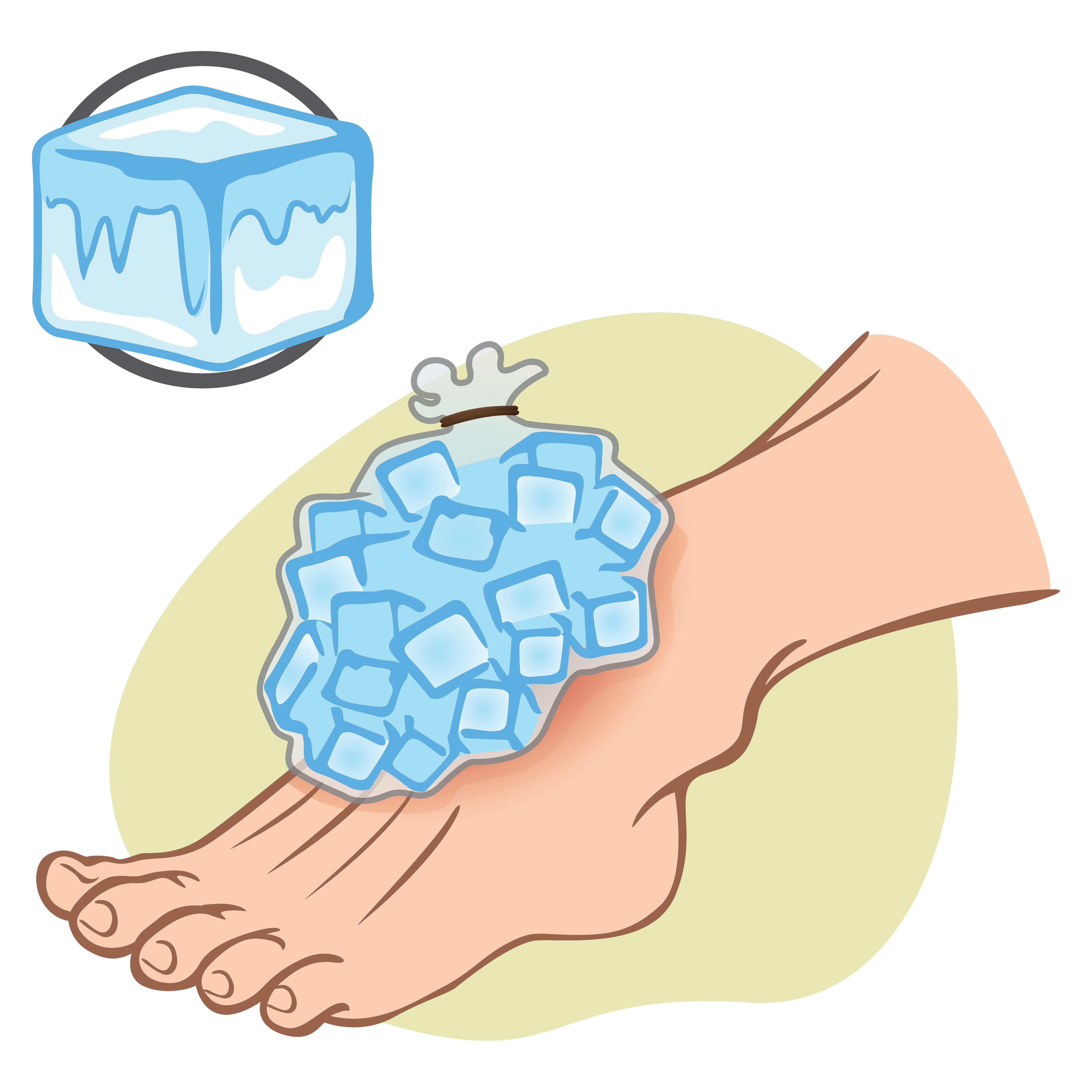 Basics of Hot and Cold Therapy