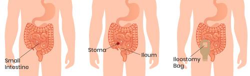 What is an Ileostomy?