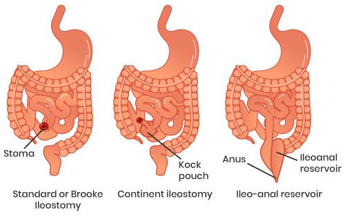 Types of Ileostomies