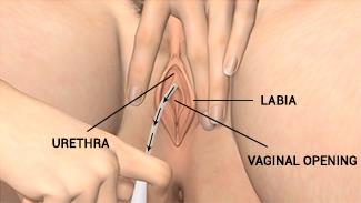 Self-Catheterization for Females