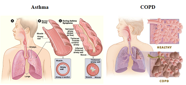 Know the Difference: Asthma and COPD