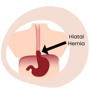 type of hernia - hiatal