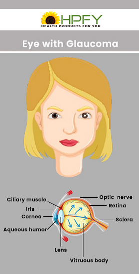 How To Prevent Glaucoma?