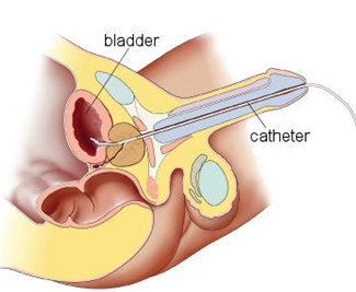 By placing catheters below the marked bra line, catheters are not