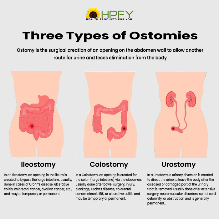 Three Types of Ostomies