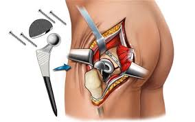 hip replacement