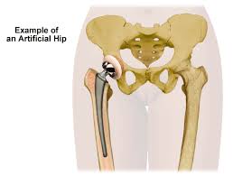 hip replacement